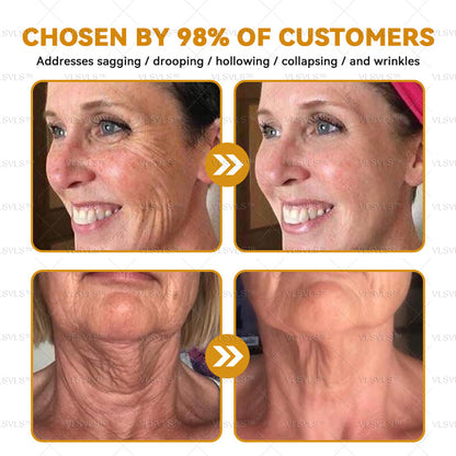 Mayo Clinic Official: VLSVLS™ Bee Venom Skin Restoration Cream, Anti-aging, Hydrating, Skin Repair, Even Tone, Acne and Dark Spot Treatment, Wart and Mole Removal, Psoriasis Relief🥇🥇