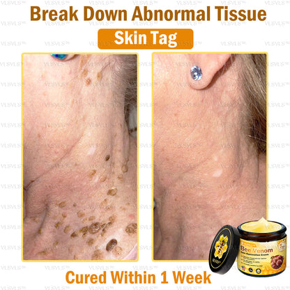 Mayo Clinic Official: VLSVLS™ Bee Venom Skin Restoration Cream, Anti-aging, Hydrating, Skin Repair, Even Tone, Acne and Dark Spot Treatment, Wart and Mole Removal, Psoriasis Relief🥇🥇