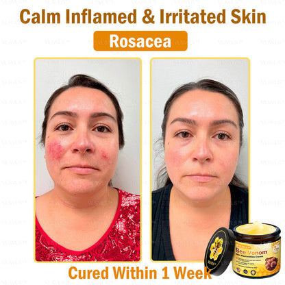 Mayo Clinic Official: VLSVLS™ Bee Venom Skin Restoration Cream, Anti-aging, Hydrating, Skin Repair, Even Tone, Acne and Dark Spot Treatment, Wart and Mole Removal, Psoriasis Relief🥇🥇