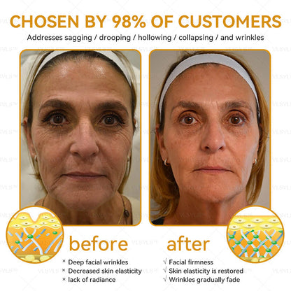Mayo Clinic Official: VLSVLS™ Bee Venom Skin Restoration Cream, Anti-aging, Hydrating, Skin Repair, Even Tone, Acne and Dark Spot Treatment, Wart and Mole Removal, Psoriasis Relief🥇🥇